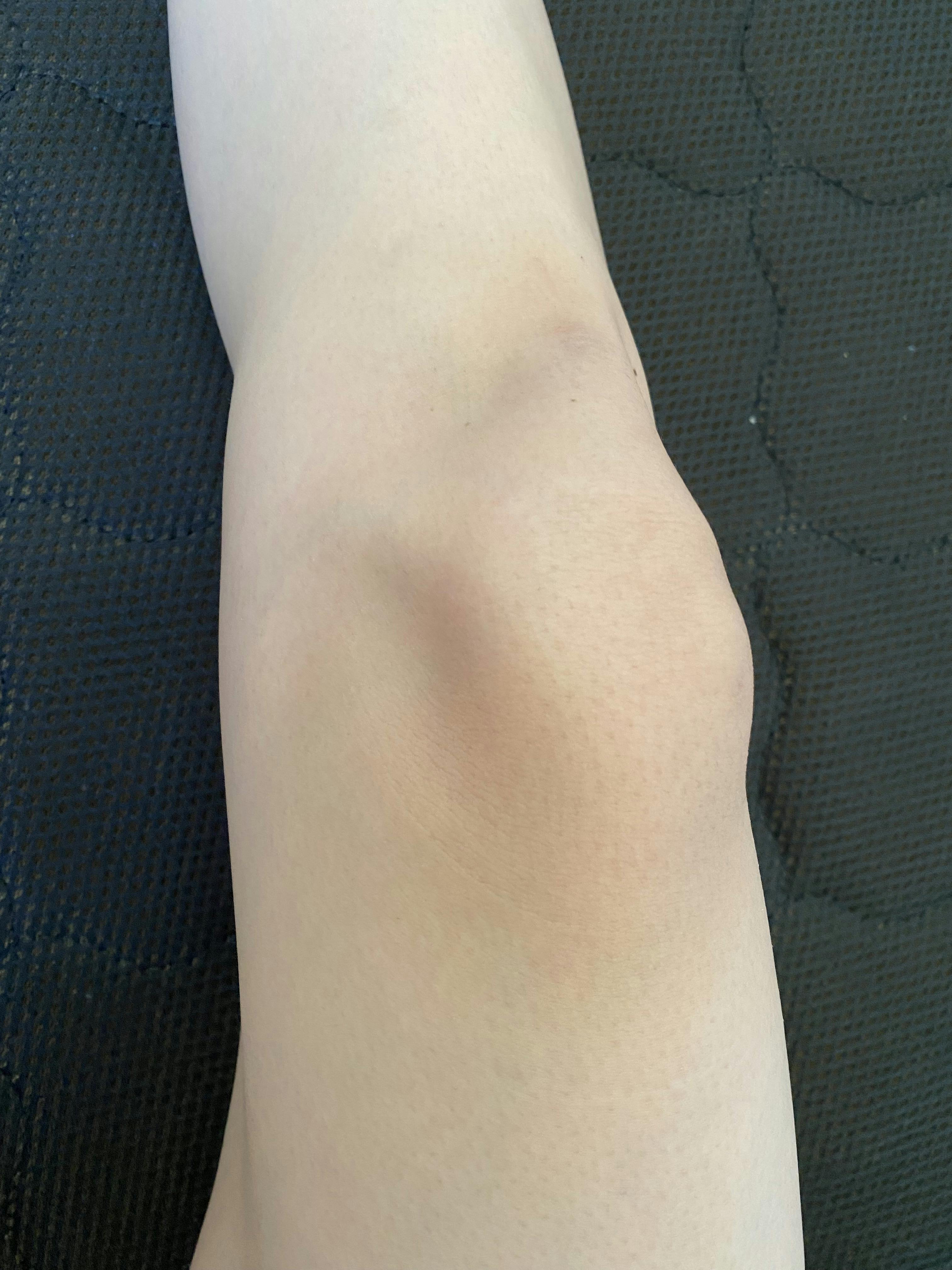 湘南美容クリニック 名古屋院で医療脱毛・鼻下の医療脱毛・乳輪の医療脱毛・うなじの医療脱毛・手の指・甲の医療脱毛・医療脱毛(顎下・首)・顎の医療脱毛・足の指・甲の医療脱毛・額の医療脱毛・Vライン医療脱毛・Iライン医療脱毛・Oライン医療脱毛・膝の医療脱毛・へそまわりの医療脱毛を受けたあいさんの写真