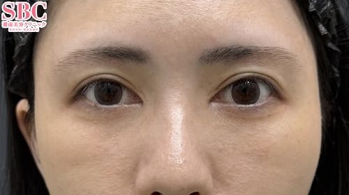 【20代女性・目元】目の下の切らないクマ・たるみ（ふくらみ）取り ナチュラル脂肪注射コンデンスリッチ ナチュラル脂肪注射ナノリッチ_after