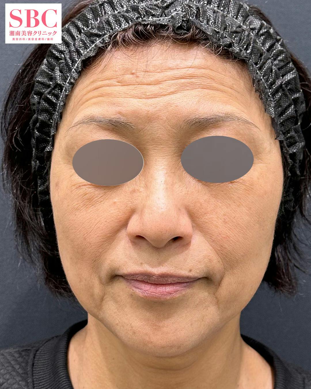 【女性・たるみ】スマスフェイスリフト_before