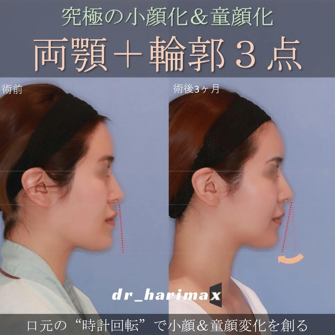 【女性・顔】上下顎骨切り術・輪郭3点_before_aftar