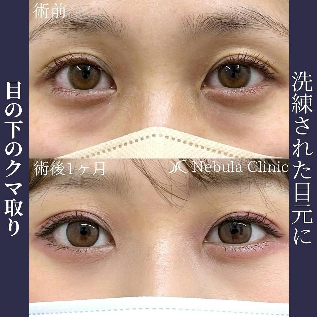 【女性・クマ】切らない目の下のクマ取り・たるみ取り_before_aftar