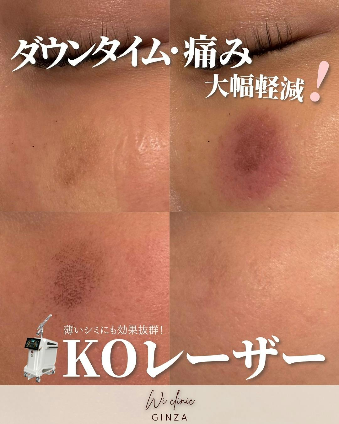 【女性・シミ】KOフラクショナル_before_aftar