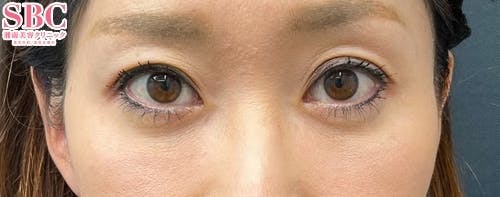 【40代女性・目元】ナチュラル脂肪注射コンデンスリッチ、ナチュラル脂肪注射ナノリッチ、目の下の切らないクマ・たるみ（ふくらみ）取り_after