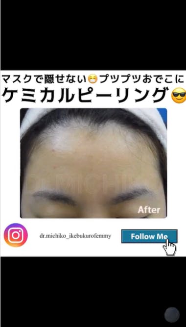 【ニキビ】ケミカルピーリング_after