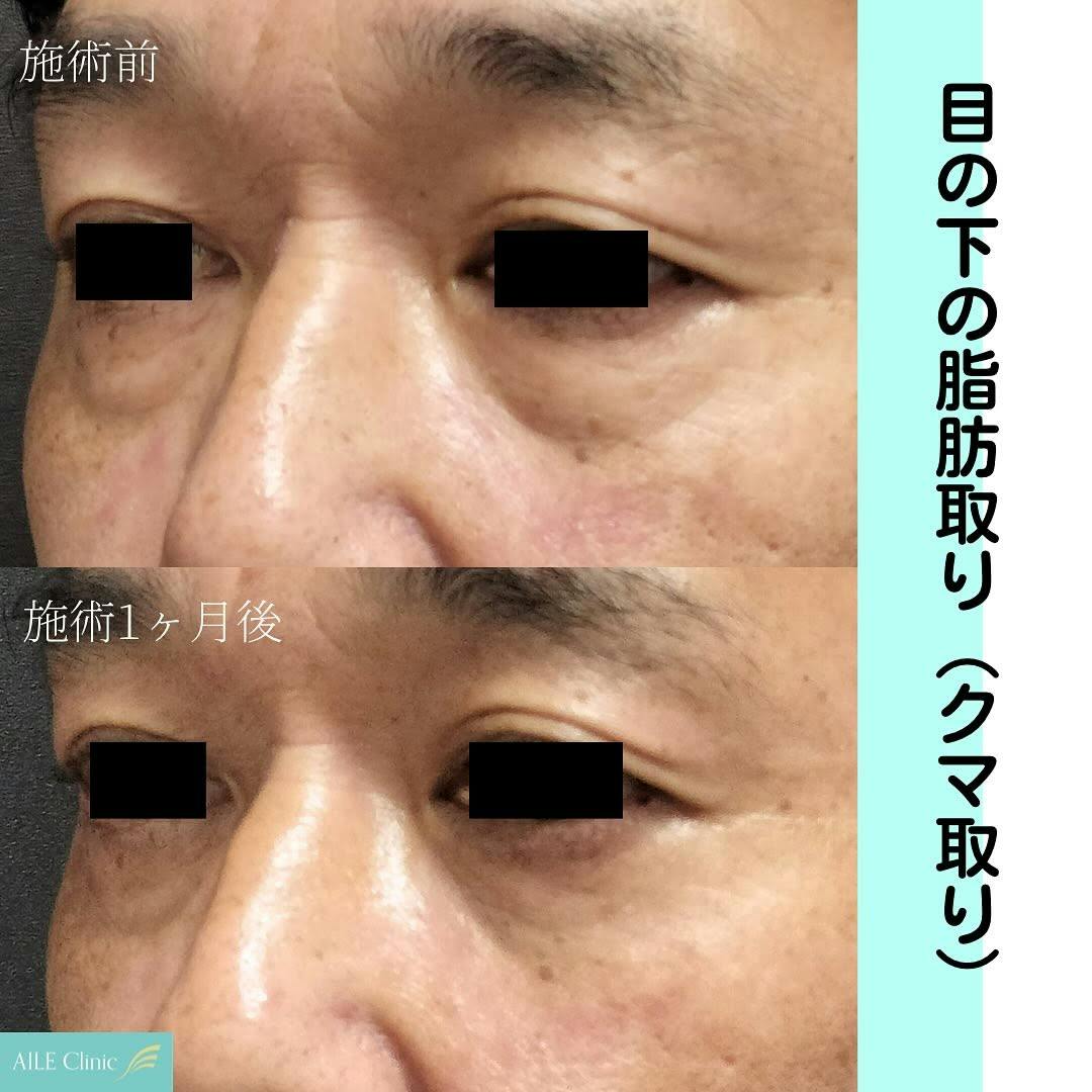 【男性・クマ】目の下の脂肪取り(クマ取り)_before_aftar