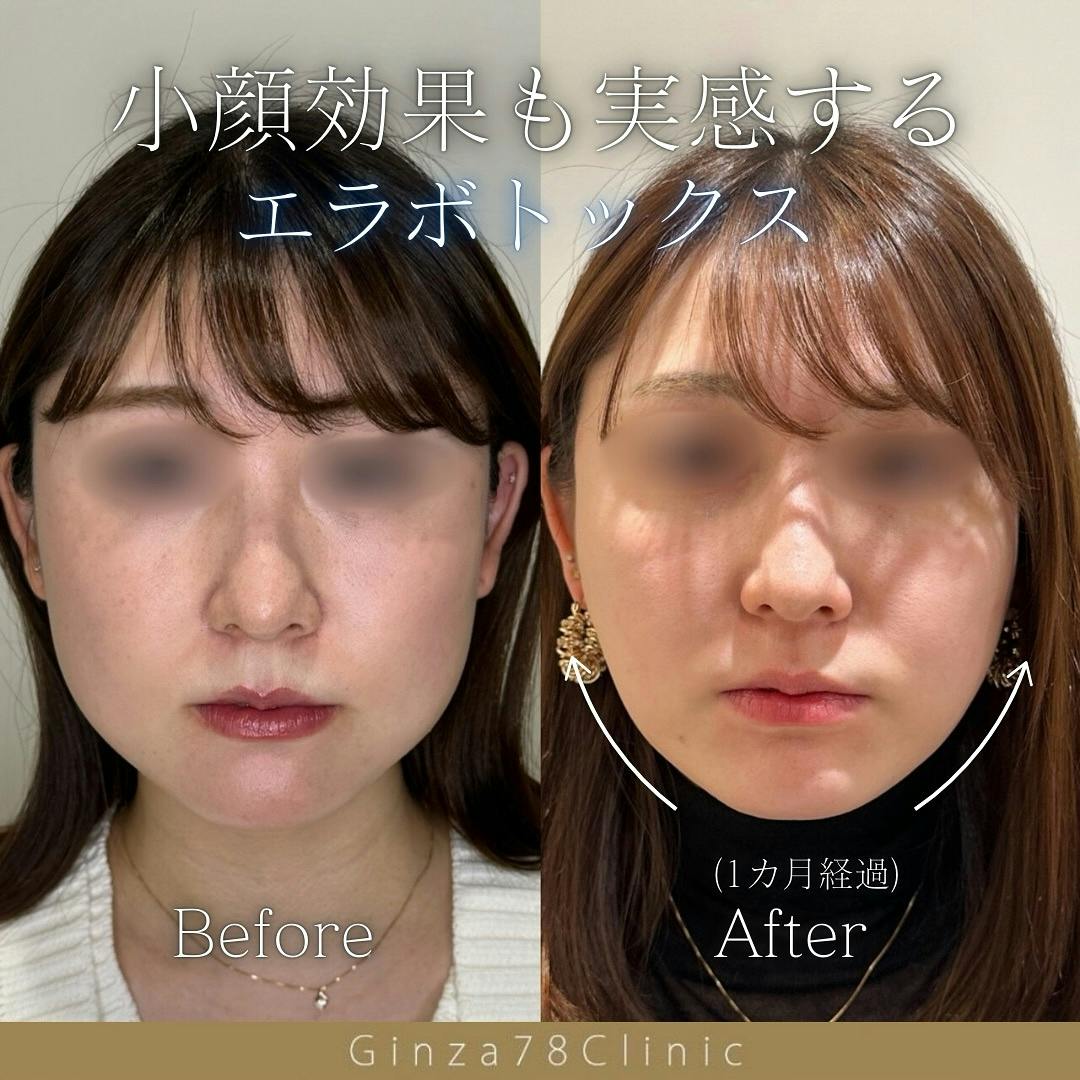 ボトックス注射・エラボトックス注射(小顔)・韓国製ボトックス・ボツリヌストキシン・アラガン製ボトックスの症例写真・ビフォーアフター画像No.713 |  Ginza78Clinic(銀座セブンエイトクリニック) | 担当：田中 耕太郎, image size:1080x1080