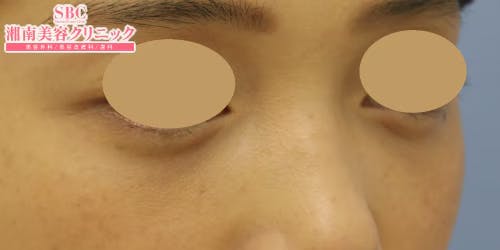 【女性・目元】目の下の切らないクマ・たるみ（ふくらみ）取り、ナチュラル脂肪注射コンデンスリッチ_aftar