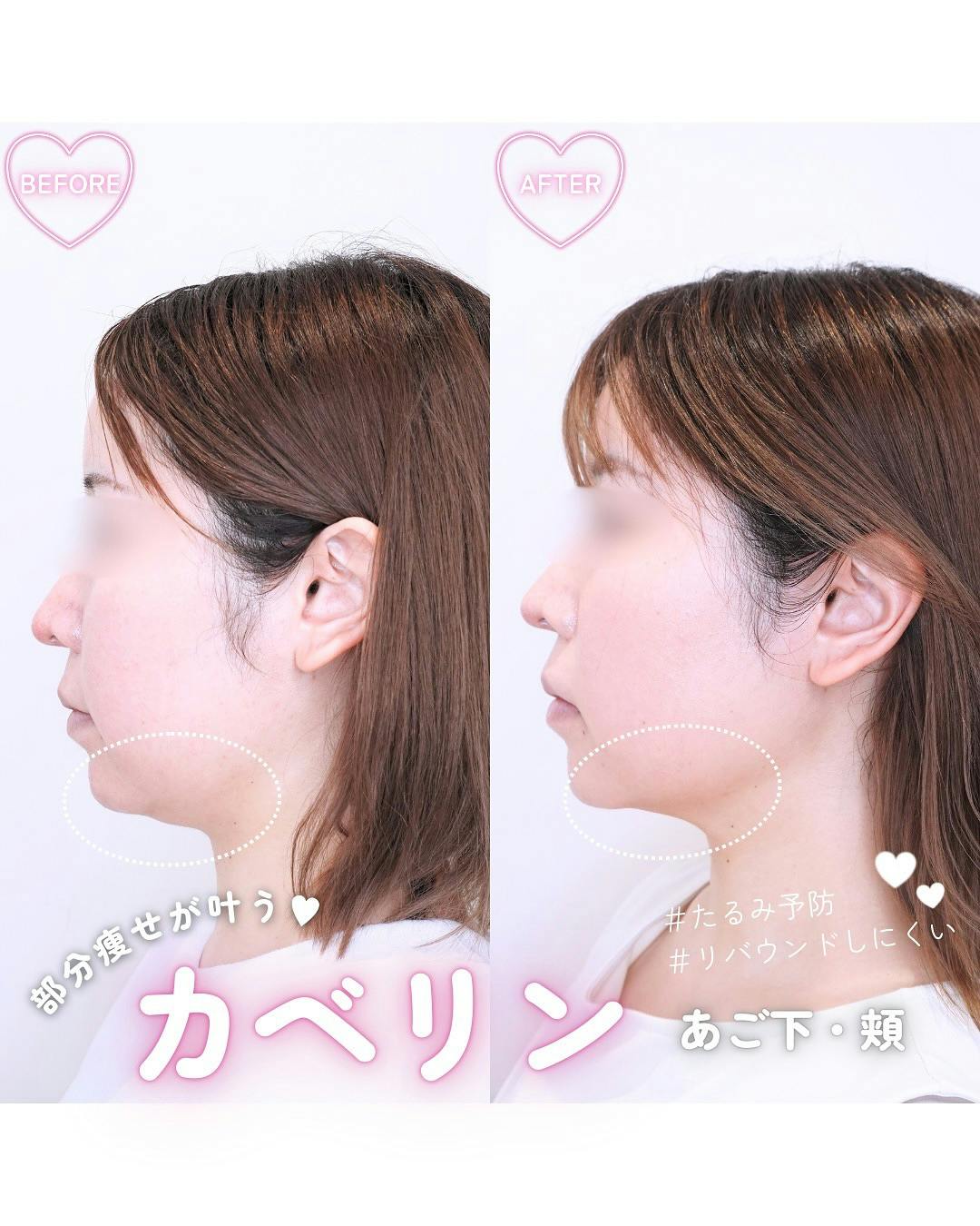 【女性・顔】カベリン あご下・頬_before_aftar