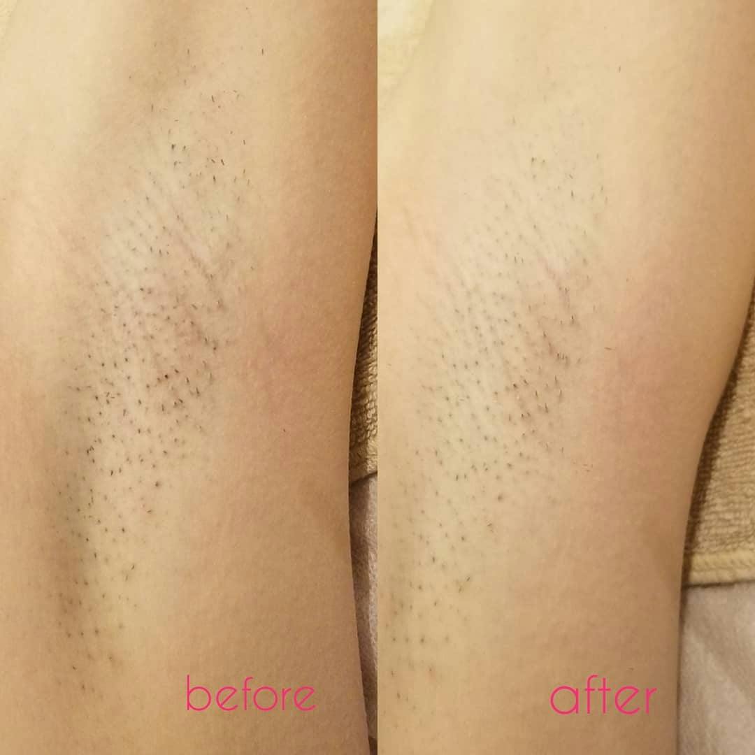 【女性・脇】トーニング_before_aftar