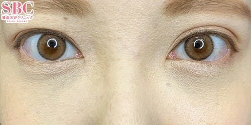 【女性・目元】目の下の切らないクマ・たるみ（ふくらみ）取り、ナチュラル脂肪注射コンデンスリッチ_after