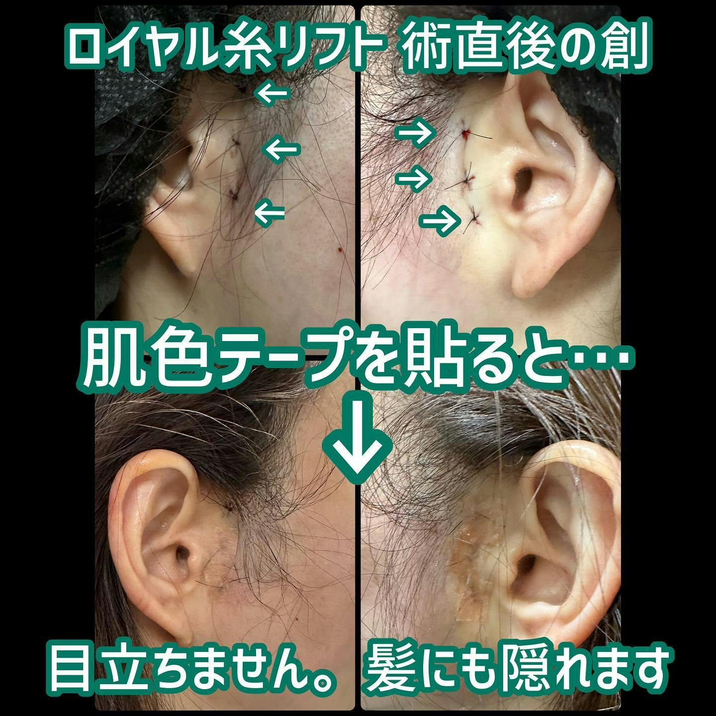 【女性・創】ロイヤル糸リフト_before_aftar