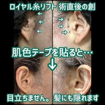 【女性・創】ロイヤル糸リフト_before_aftar