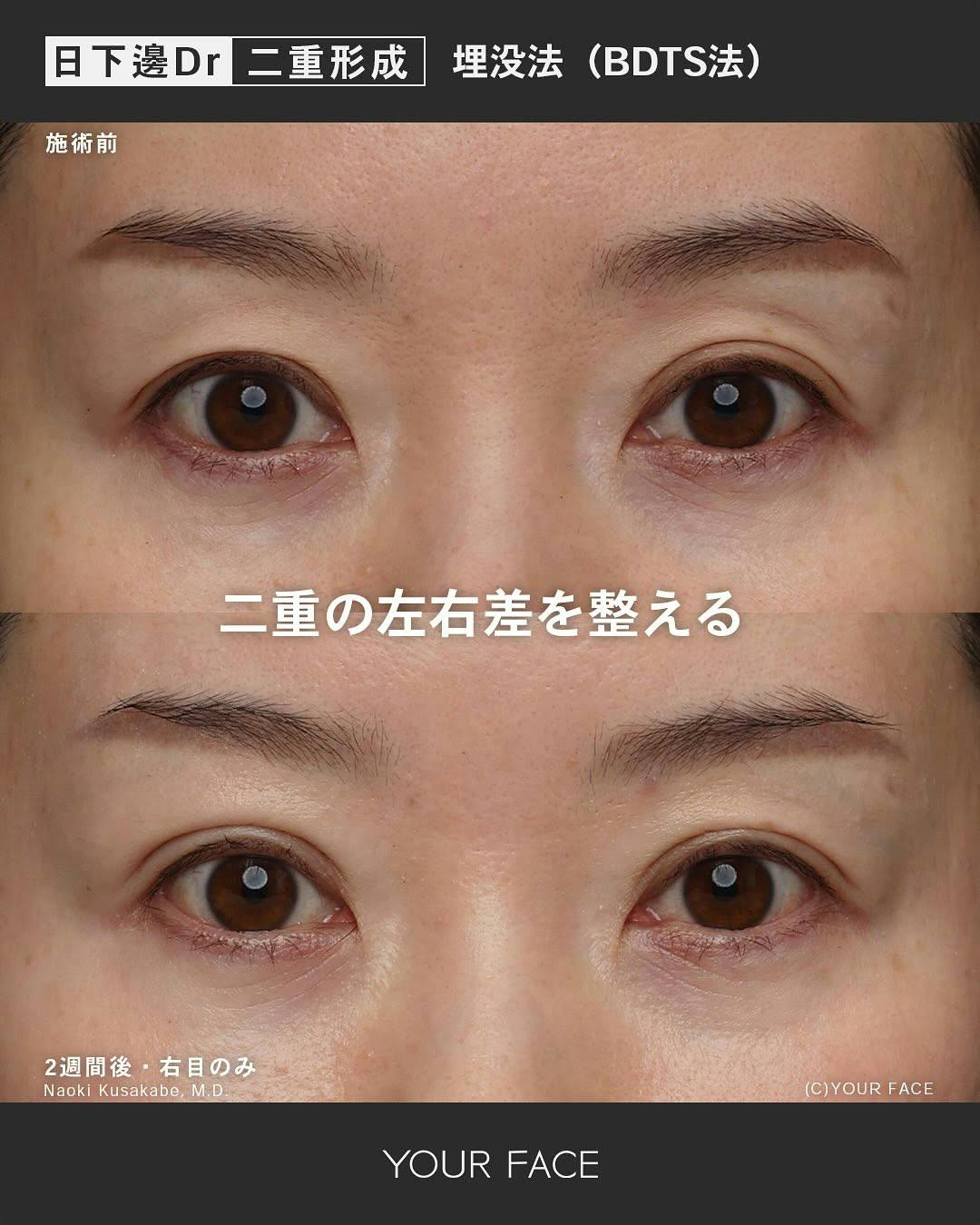 【女性・目元】埋没法（BDTS法）_before_aftar