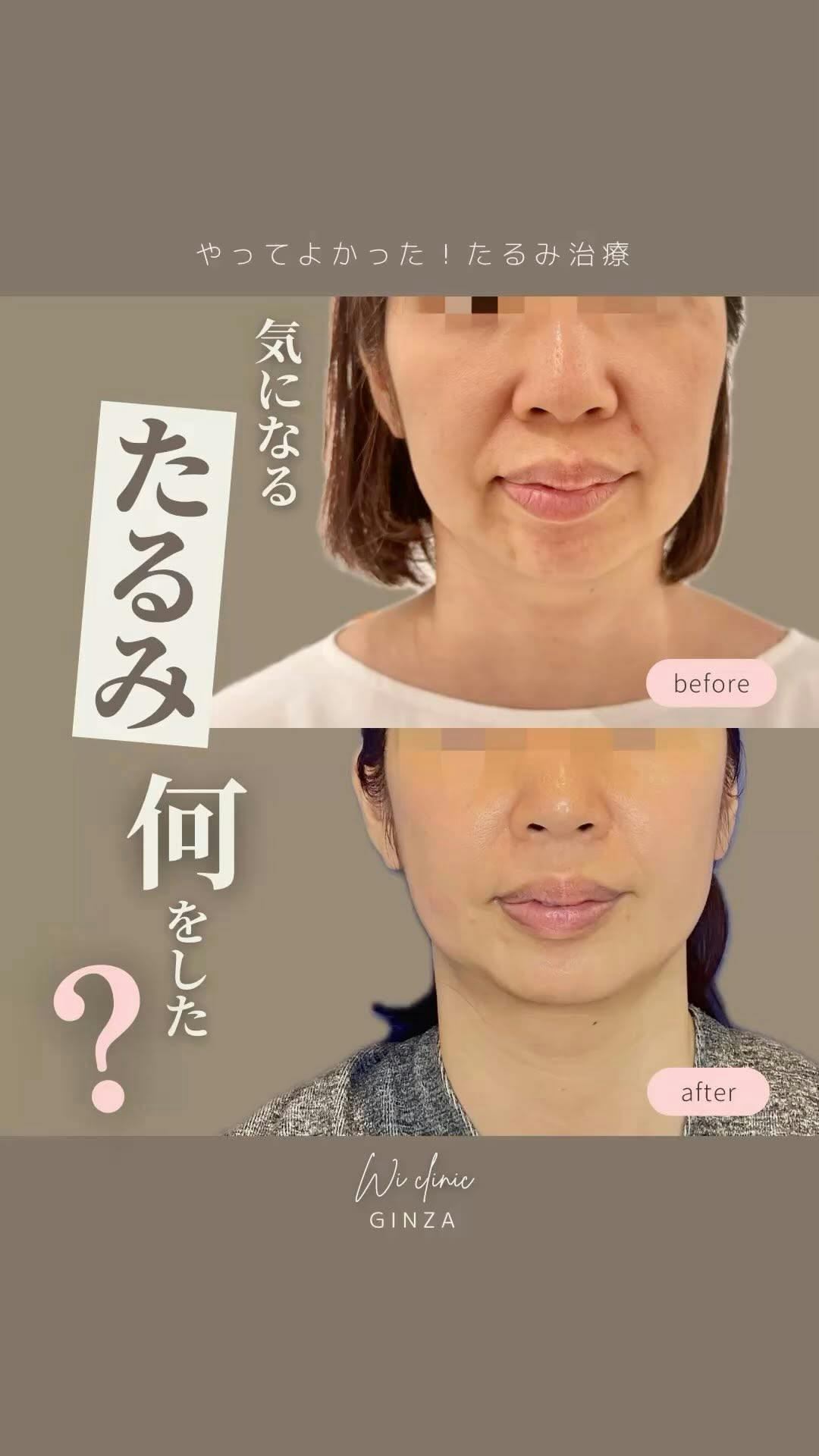 【40代女性・たるみ】サーマジェン_before_aftar