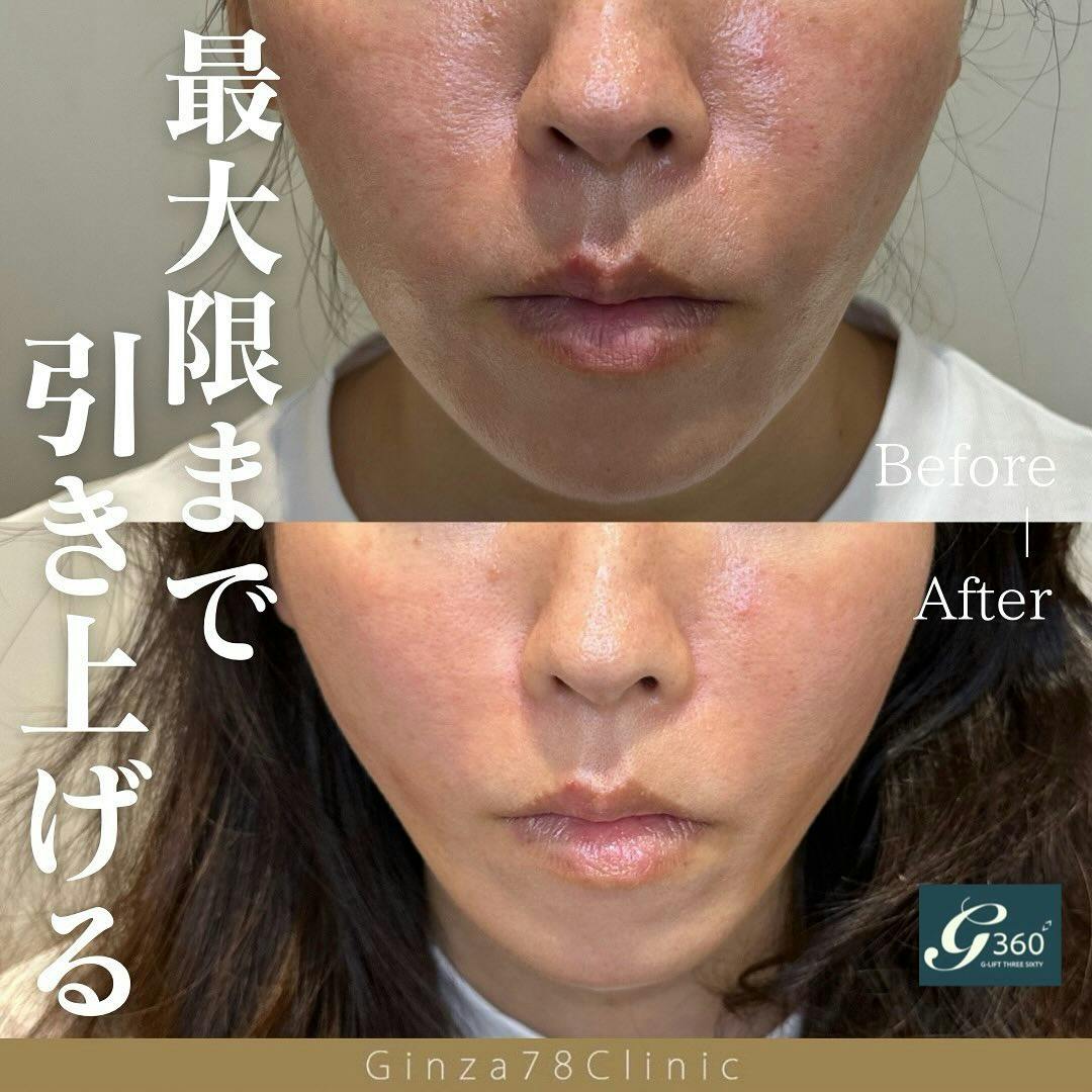 【女性・小顔】糸リフト_before_aftar