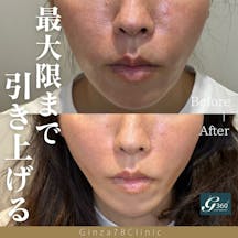 【女性・小顔】糸リフト_before_aftar