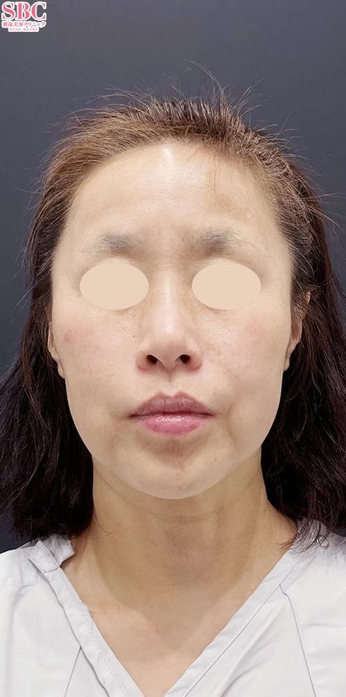 【50代女性・たるみ】ヒアルロン酸_before