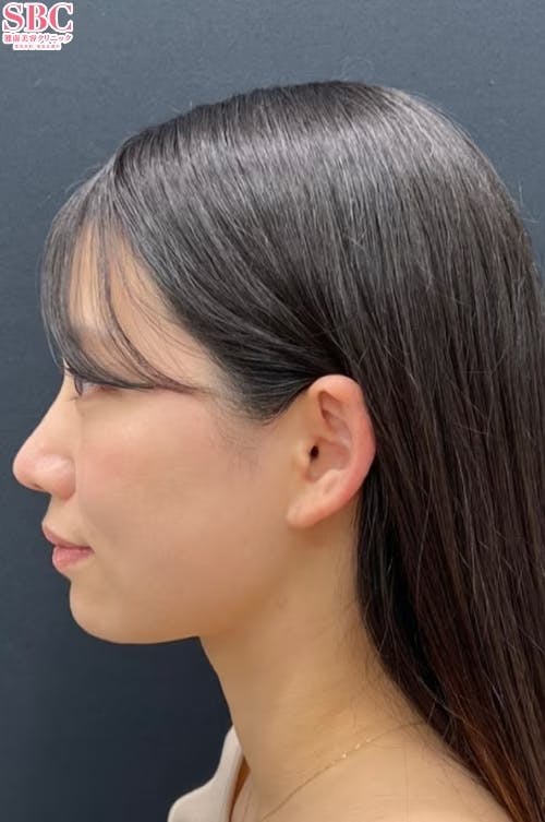 【20代女性・顔】Aquicell（アキーセル）脂肪吸引、ジョールファット除去術、エンブレイスRF、糸リフト_after