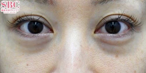 【女性・クマ】目の下の切らないクマ・たるみ（ふくらみ）取り、ナチュラル脂肪注射、VOV（ボブ）リフト_before