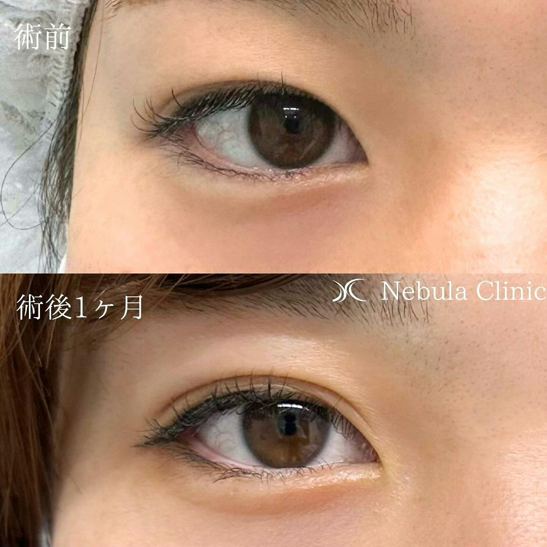 【女性・目元】二重埋没法_before_aftar