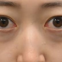 【20代女性・目元】目の下の切らないクマ・たるみ(ふくらみ)取り ナチュラル脂肪注射コンデンスリッチ ナチュラル脂肪注射ナノリッチ_before