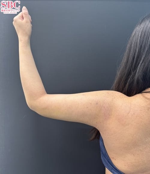【女性・二の腕】美ボディ脂肪吸引_1week