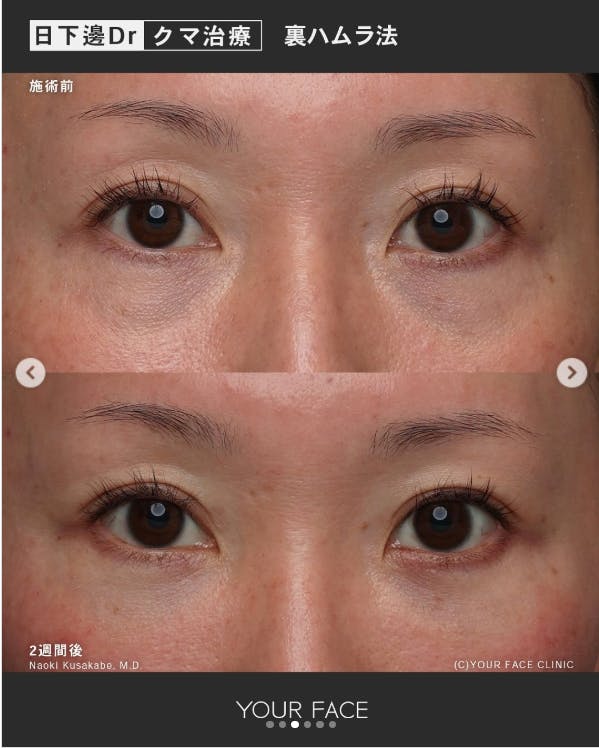 【女性・クマ】裏ハムラ法_before_aftar