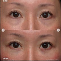 【女性・クマ】裏ハムラ法_before_aftar