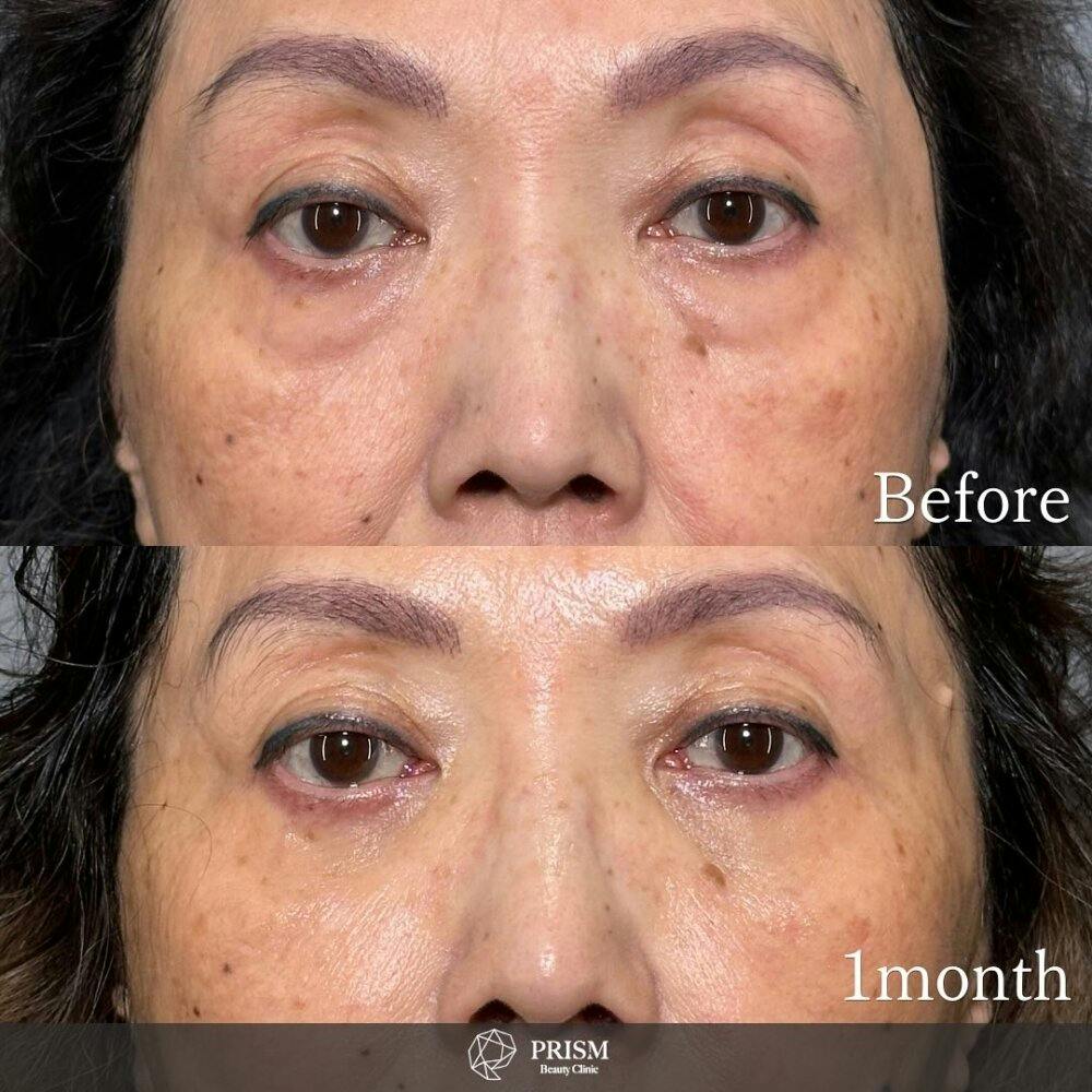 【60代女性・目】切らない目の下のクマ取り（経結膜脱脂術）_before_aftar