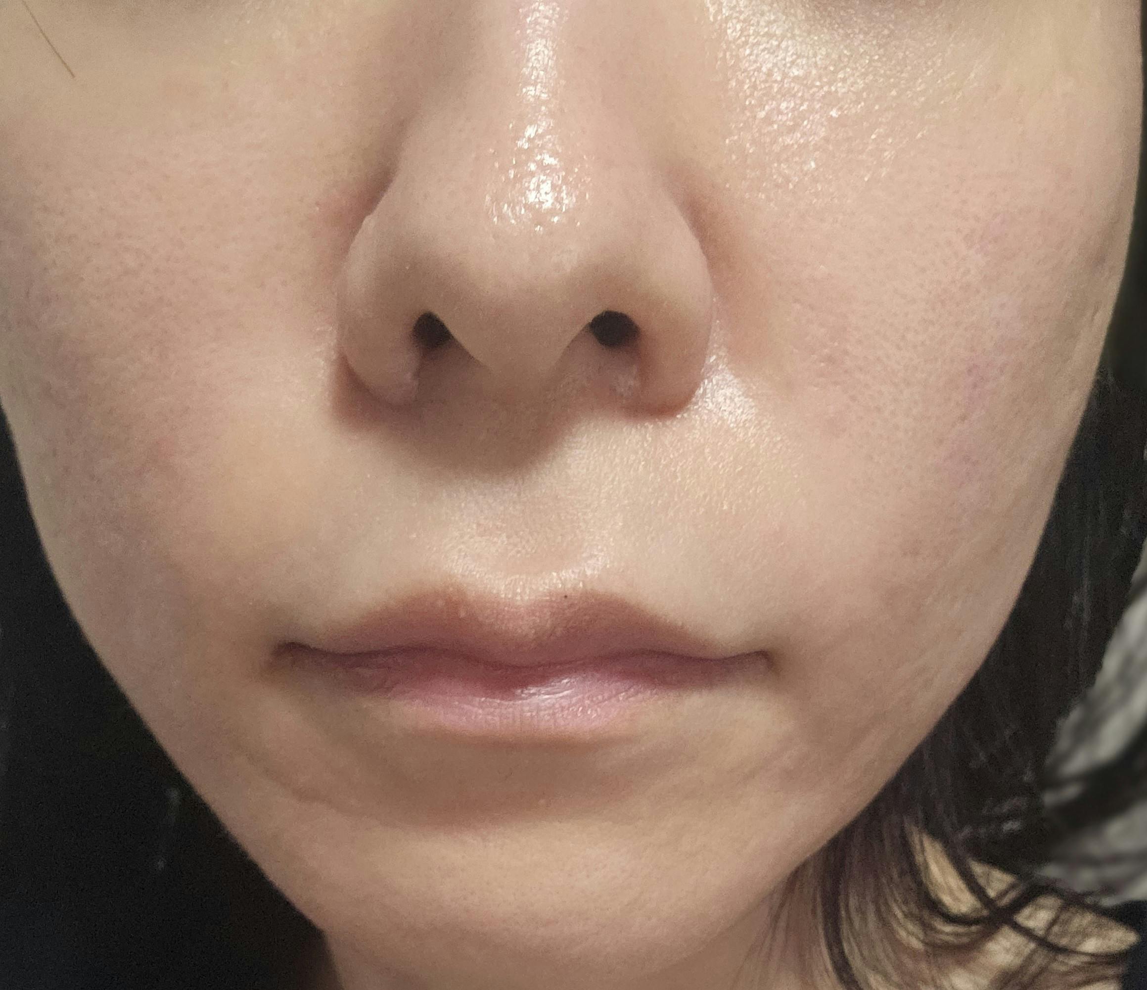 湘南美容クリニック 仙台院でプロファイロを受けたYSさんの写真