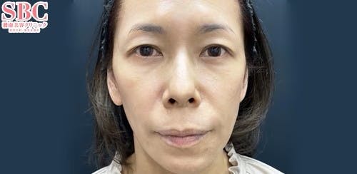 【女性・目元】目の下の切らないクマ・たるみ（ふくらみ）取り、ナチュラル脂肪注射コンデンスリッチ、ナチュラル脂肪注射ナノリッチ_after