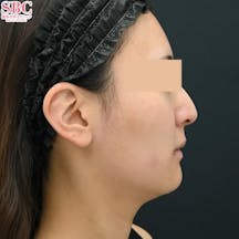 【女性・輪郭】美ボディ脂肪吸引_before