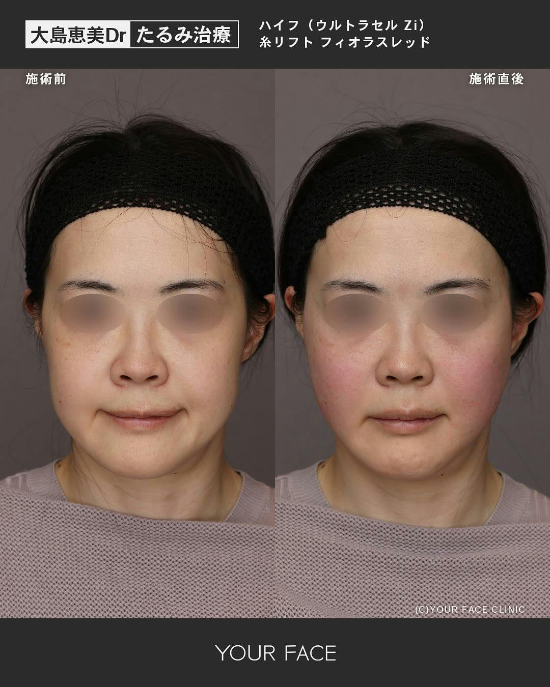 【女性・たるみ】ハイフ・糸リフトハイフ・糸リフト_before_aftar
