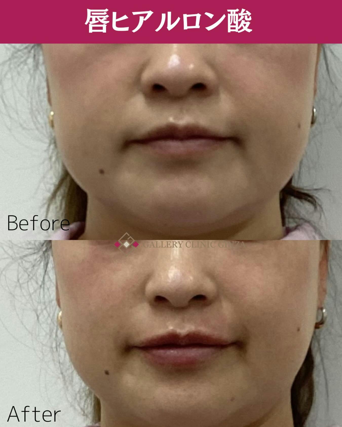 【女性・唇】ヒアルロン酸(唇)_before_aftar