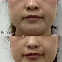 【女性・唇】ヒアルロン酸(唇)_before_aftar