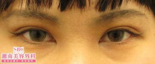 【女性・目元】クイックコスメティーク・ダブルNeo・クイックコスメティーク・シングルNeo・目頭切開プレミアム_aftar