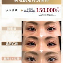 【女性・目元】クマ取り_before_aftar