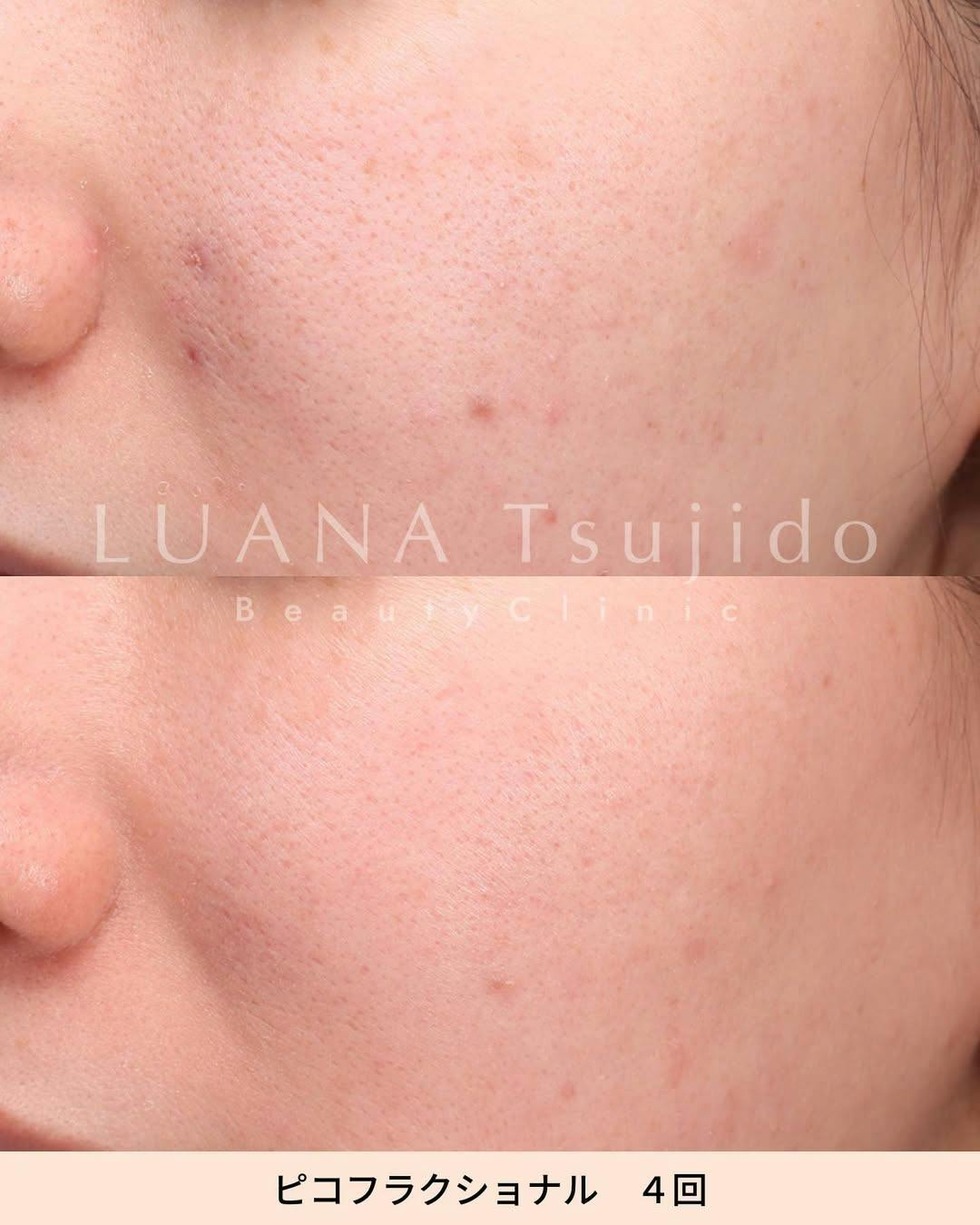 【女性・顔】ピコフラクショナル_before_aftar