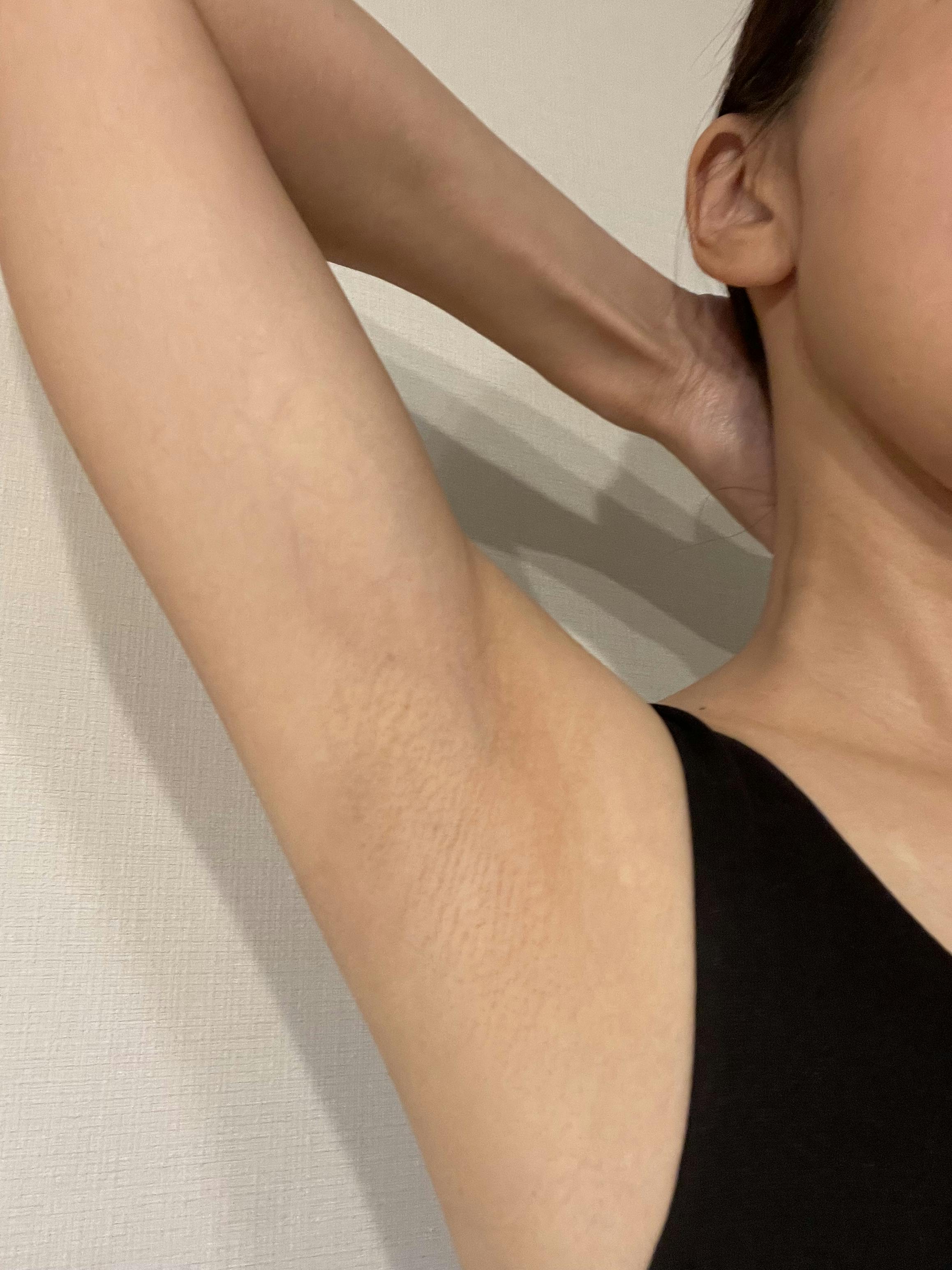 湘南美容クリニック 表参道院で医療脱毛・医療脱毛(ワキ)を受けたさやさんの写真