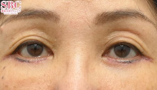 【60代女性・たるみ】アイバックリムーブ法 ナチュラル脂肪注射コンデンスリッチ_after