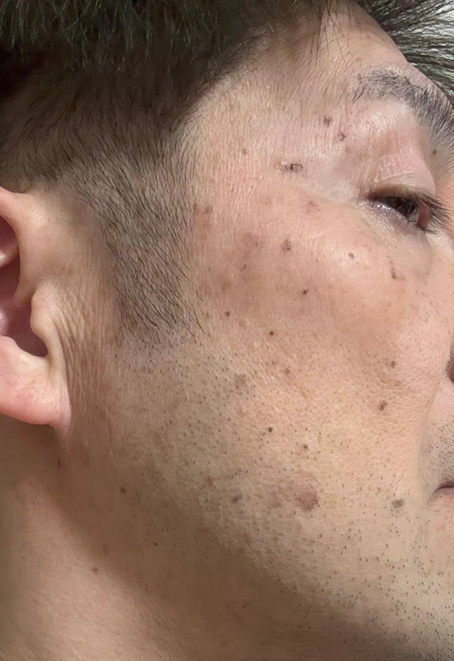 よつば会クリニック 森ノ宮院でシミ取り　顔を受けたhayabusaさんの写真