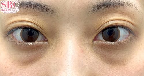 【20代女性・目元】目の下の切らないクマ・たるみ（ふくらみ）取り、ナチュラル脂肪注射コンデンスリッチ、ナチュラル脂肪注射ナノリッチ_before