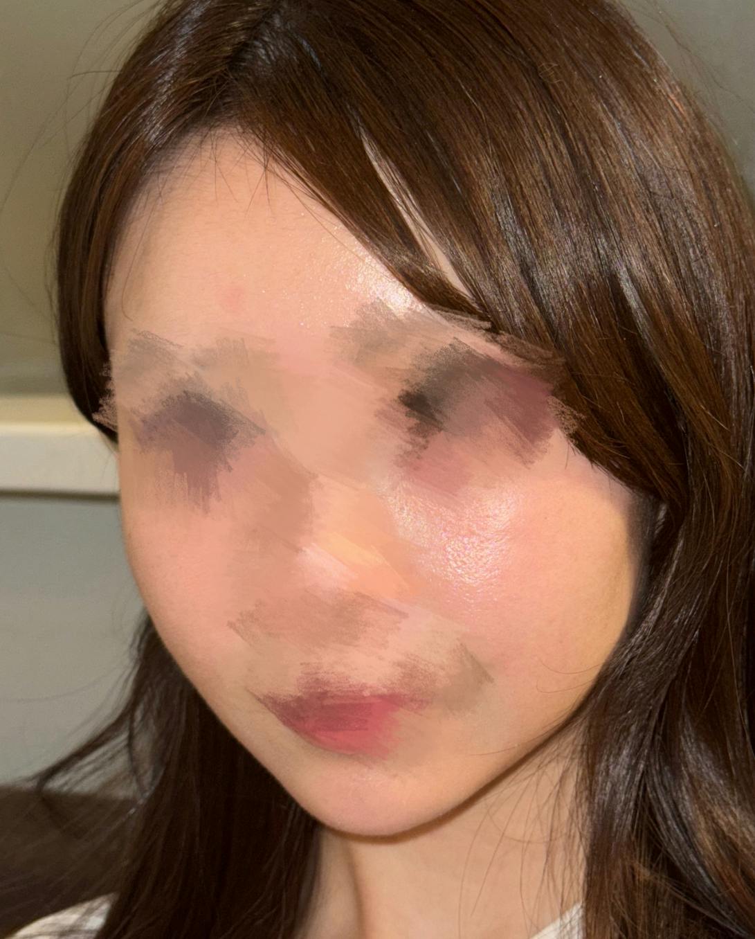 おおかみ美容のクリニック 新宿本院でマッサージピールを受けたまいさんの写真