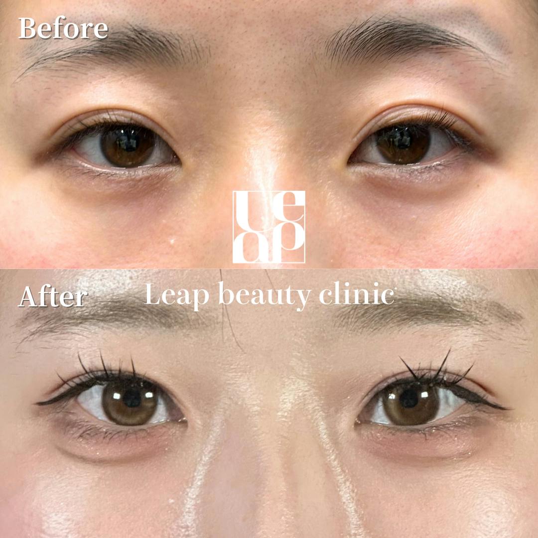 【20代女性・目元】二重埋没法・涙袋ヒアルロン酸_before_aftar