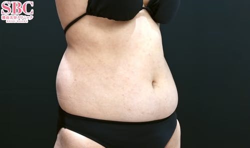 【女性・腹部】Aquicell（アキーセル）脂肪吸引_before