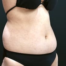 【女性・腹部】Aquicell(アキーセル)脂肪吸引_before