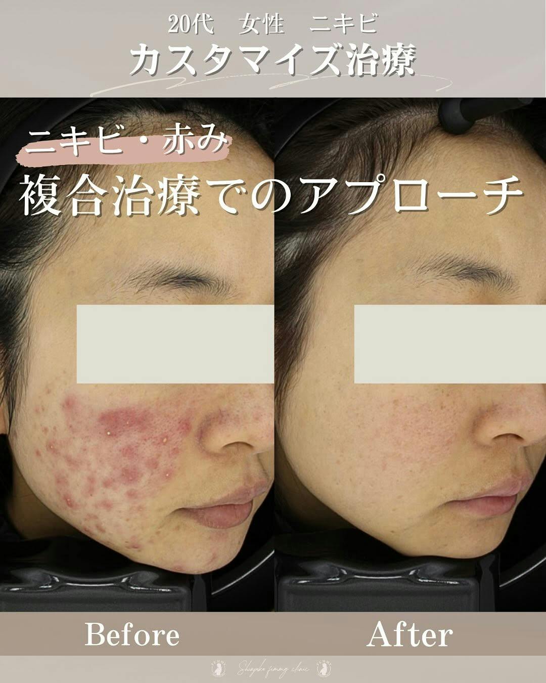 【20代女性・ニキビ】クロモライト・イソトロイン_before_aftar