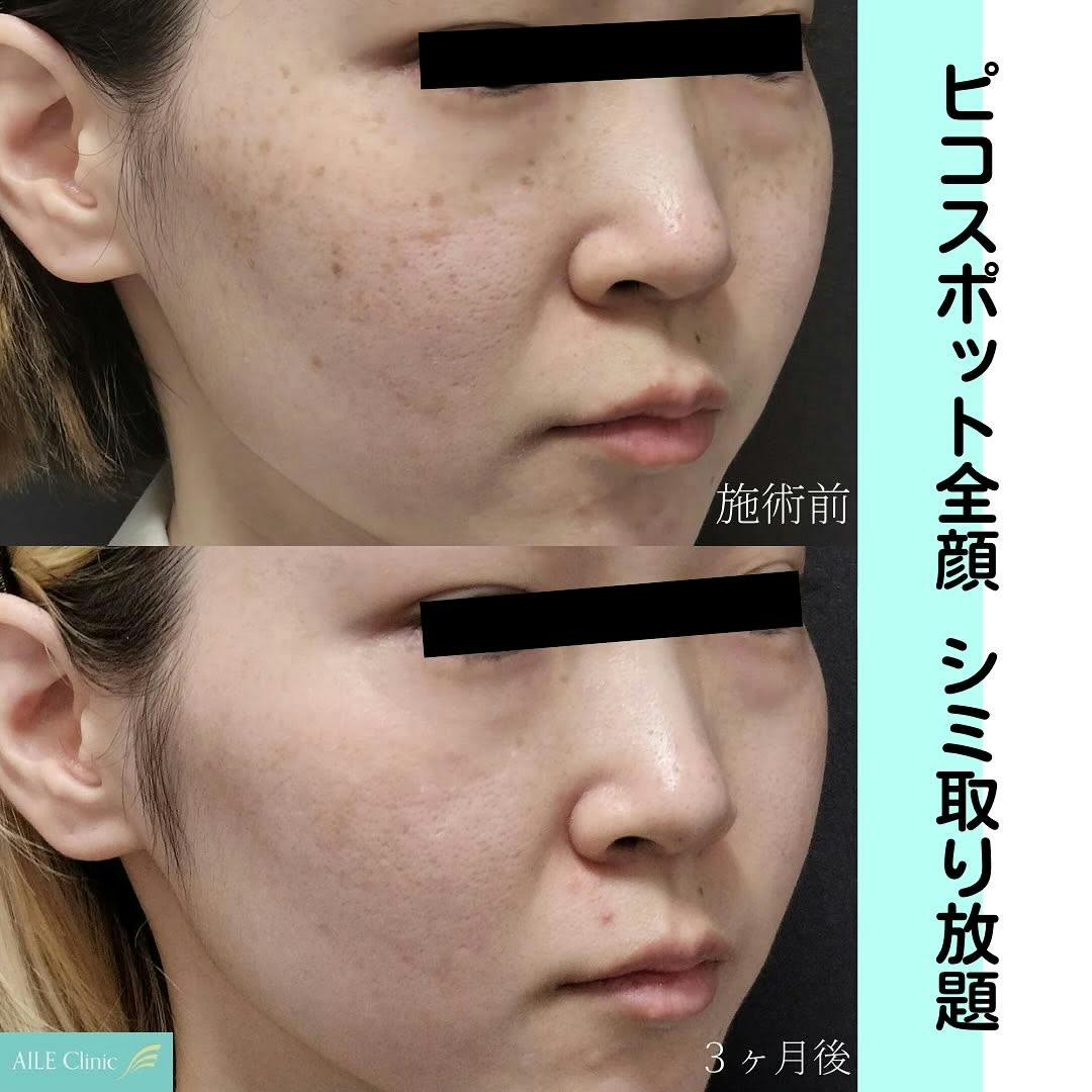【女性・シミ】ピコスポット全顔_before_aftar