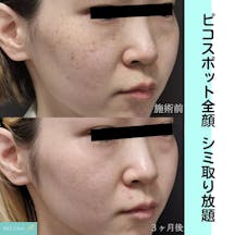 【女性・シミ】ピコスポット全顔_before_aftar