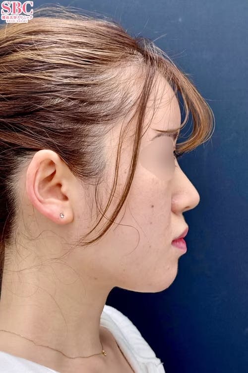 【女性・輪郭】小顔用脂肪吸引注射・ボトックス_aftar